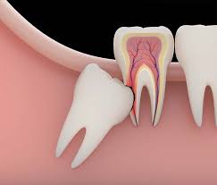 Gömük Dişler Görsel 1