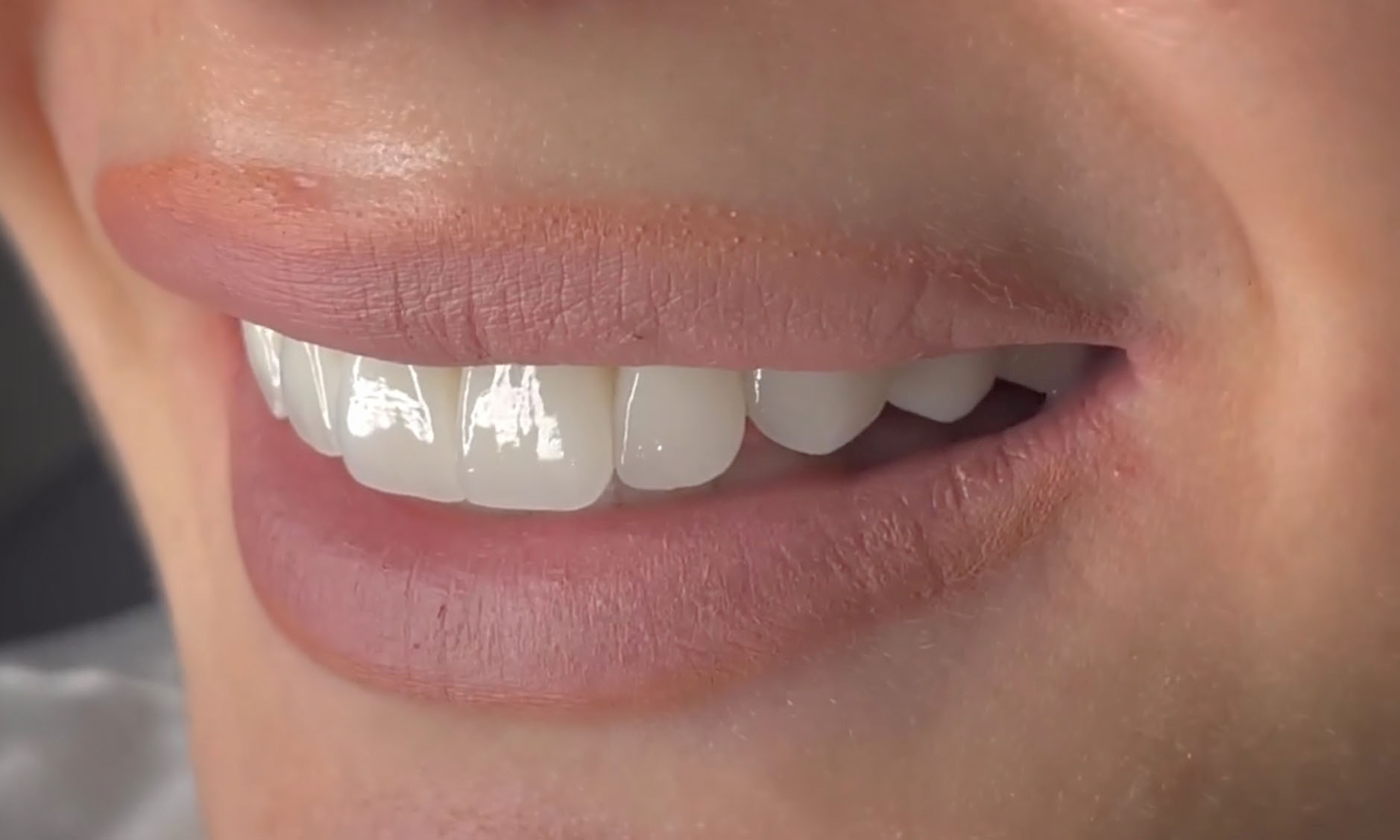 Gülüş Tasarımı Görsel 1